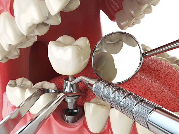 Best Emergency Dental Extractions in Hillsborough, CA