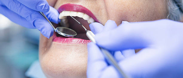 Best Emergency Dental Care for Abscessed Tooth in Hillsborough, CA